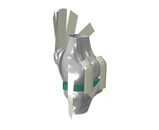 Basic TKR Loading: Evaluate whole joint mechanics during activities of daily living under basic muscle loaded conditions using the Basic TKR Loading workflow in the Abaqus Knee Simulator.